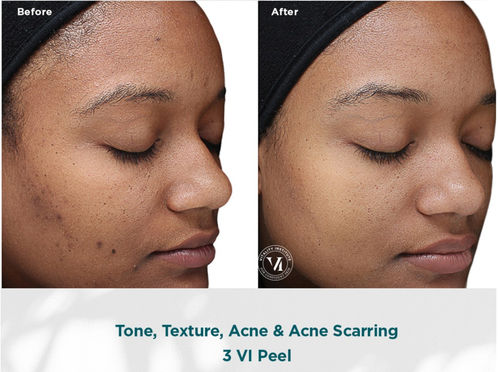 Tone, Texture, Acne & Acne Scarring