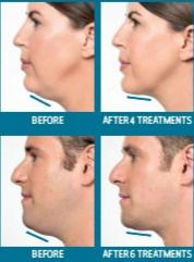 Kybella 