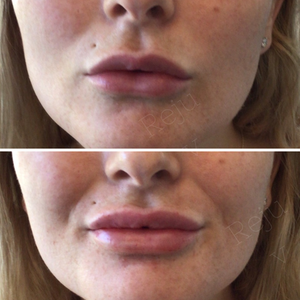 before and after lip filler