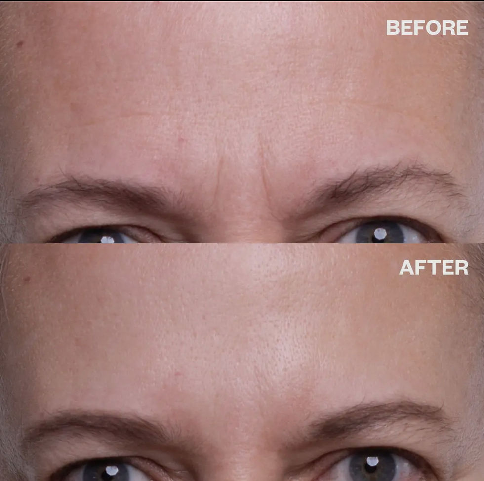 Thumbnail: Wrinkles Schminkles Forehead Wrinkle Patch 