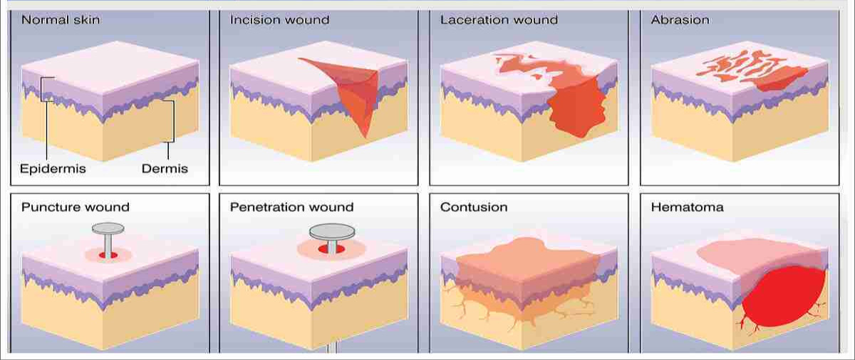 Hard Tissue Injuries Examples Soft Tissue Injuries: Assessment & Surgical Management | MedSync Blog
