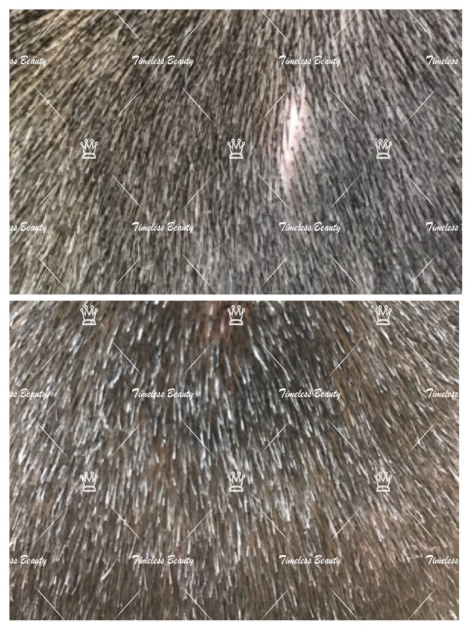 hairline restoration