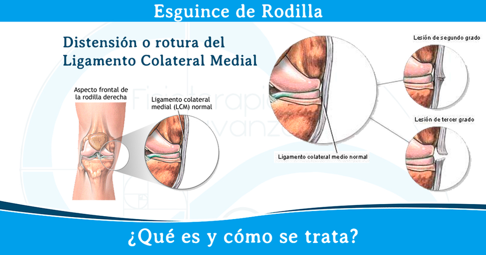 Esguince de rodilla