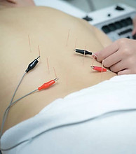 electroacupuncture-1.jpg