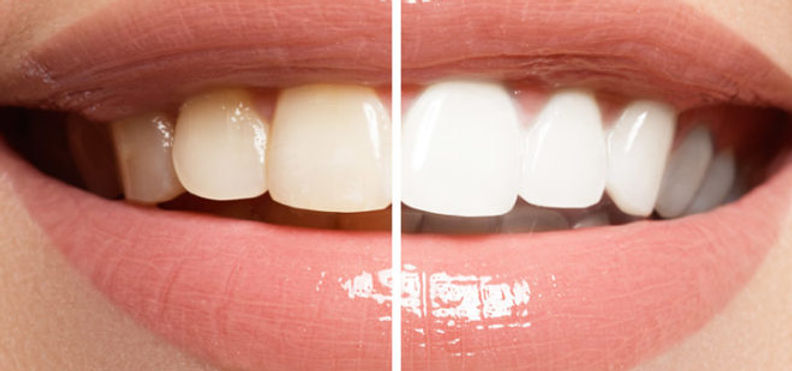 clareamento-dental-660x400.jpg