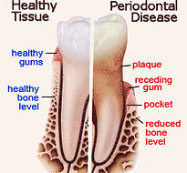 Periodontal Disease AKA Gum Disease Royston Dental Suite