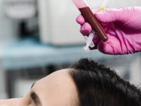 Improving Hair Density With the Best PRP Hair Treatment
