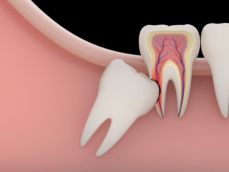 Tooth Extraction Cost Explained for Parents and Caregivers
