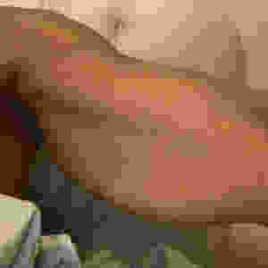 Excess skin, left arm.