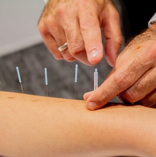 Acupuncture