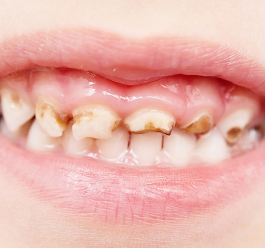 dentes-cariados-na-boca-de-uma-crianca-foto-nrtshutterstockcom-00000000000167F3.jpg
