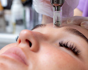 Fractional microneedle facial therapy close up.jpg