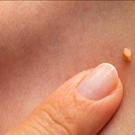 Toda verruga é HPV?