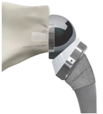 shoulder arthropathy figure 2.PNG