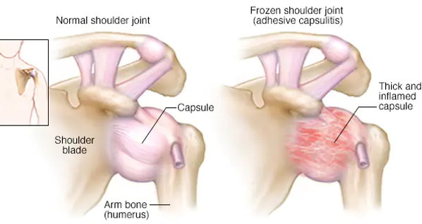 Frozen shoulder capture 2.webp