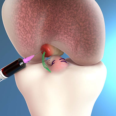 ACL Restoration.jpeg