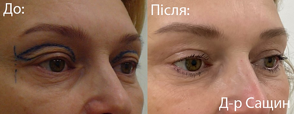 Доктор блефаропластика верхня нижня Сащи