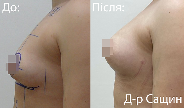 Збільшення грудей підтяжка ліфтинг Сащи