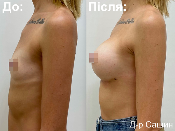 збільшення грудей львів україна віктор сащин.png