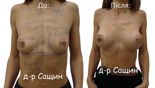 Збільшити груди Сащин Віктор Володимиров