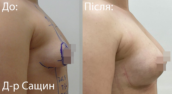 Збільшення грудей підтяжка ліфтинг Вікт