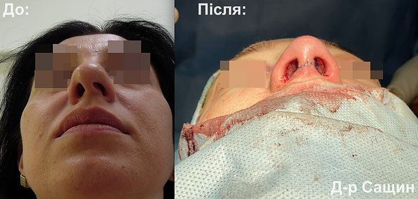блефаропластика пластика повік верхніх нижіх Сащин Віктор Володимирович.png