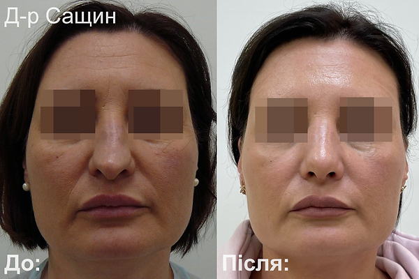 Доктор-хірург ринопластика операція ніс Сащин Віктор Володимирович.png
