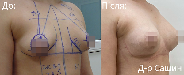 Збільшення грудей підтяжка ліфтинг Вікт