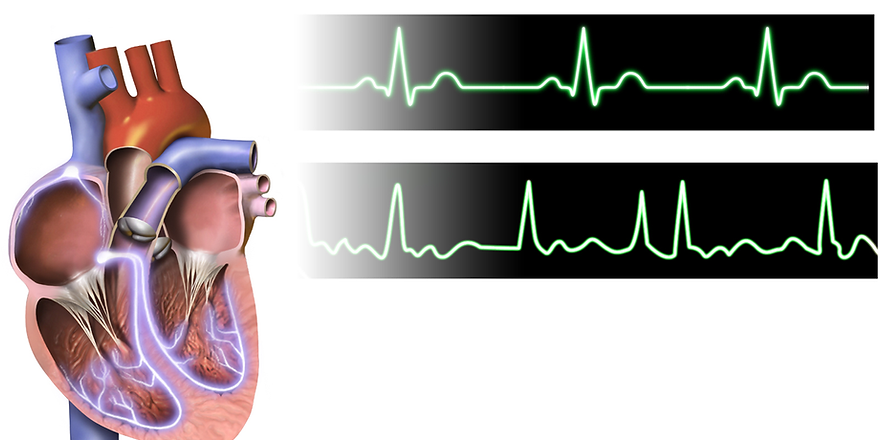Atrial_Fibrillation.png