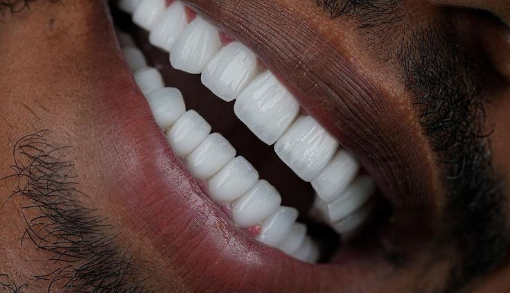 Achieve your dream smile with Lema Clini