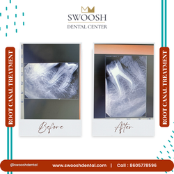 Root Canal Treatment