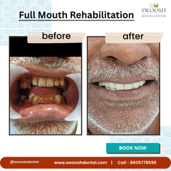 Full Mouth Rehabilitation (FMR)