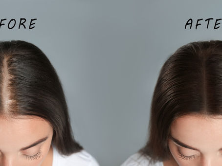 Revolutionizing Hair Loss Solutions With Scalp Micro Pigmentation