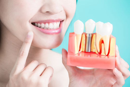 Dental Implants: The Ultimate Solution For Missing Teeth