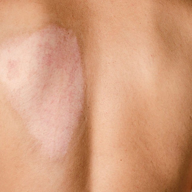 Burn mark on back scar.jpeg