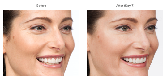 BOTOX