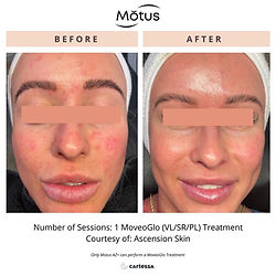 complete Moveo Glo Laser Facial