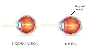 NEARSIGHTEDNESS