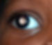 White pupil in retinoblastoma - an eye cancer found during eye exams with optometrists or ophthalmologists.
