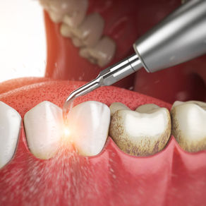 ¿Qué es la limpieza dental?