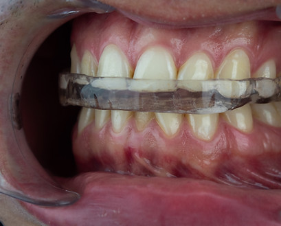 guarda dental