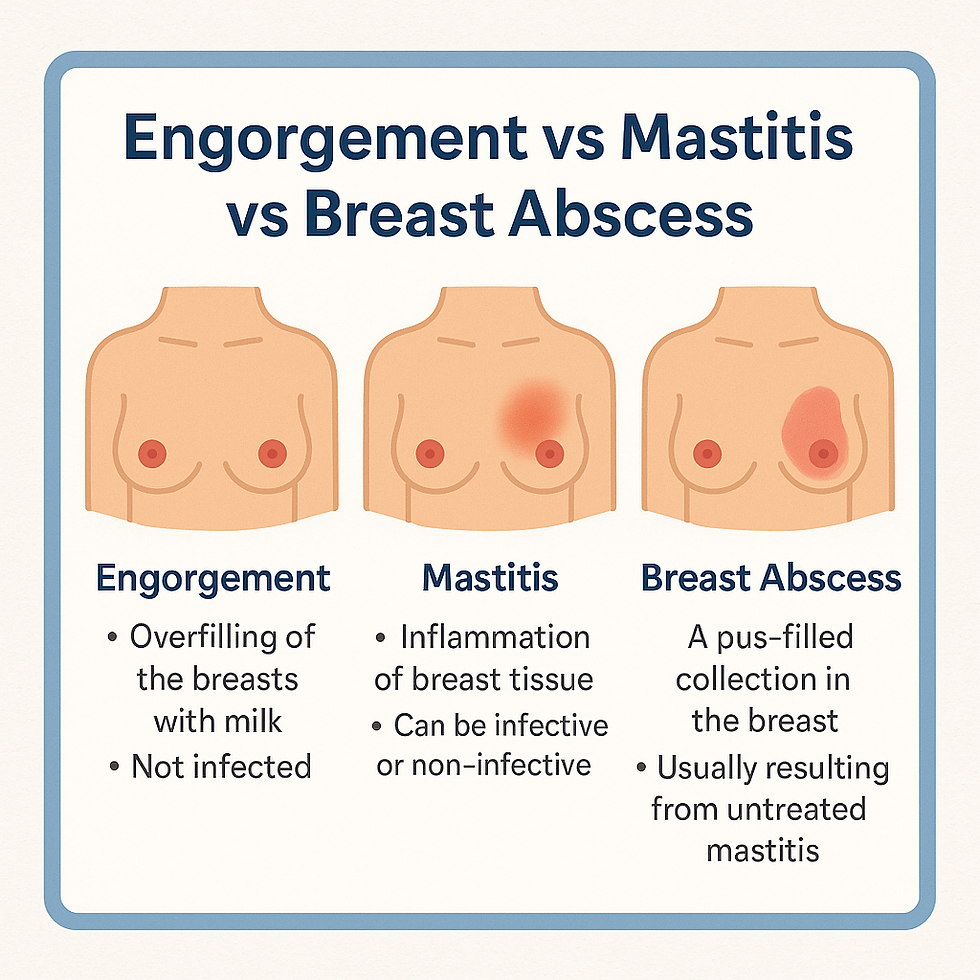PLAB 2 educational infographic illustrating breast engorgement, mastitis, and breast abscess with simple diagrams and clinical descriptions.