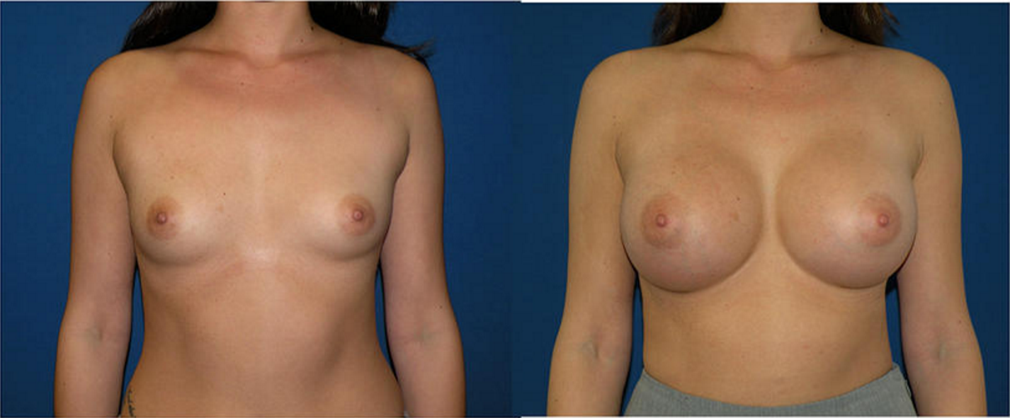 Breast Augmentation, Breast Imimage1
