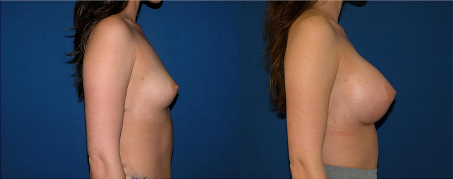 Breast Augmentation, Breast Implant