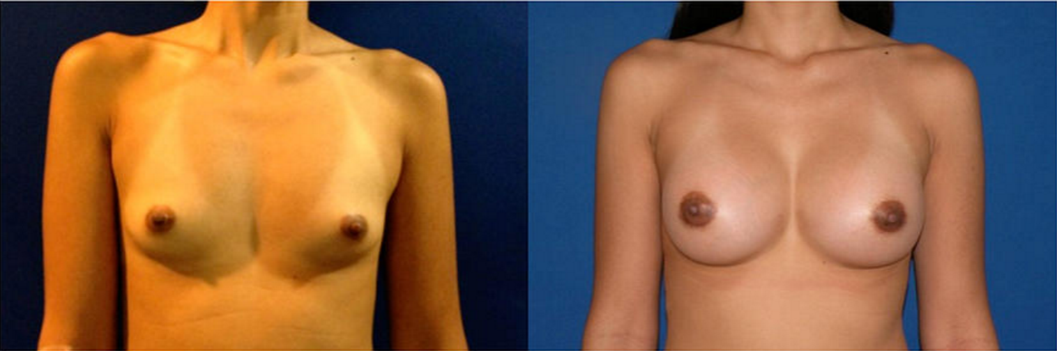 Breast Augmentation, Breast Implant