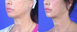 Neck Lift