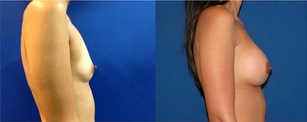 Breast Augmentation, Breast Implant