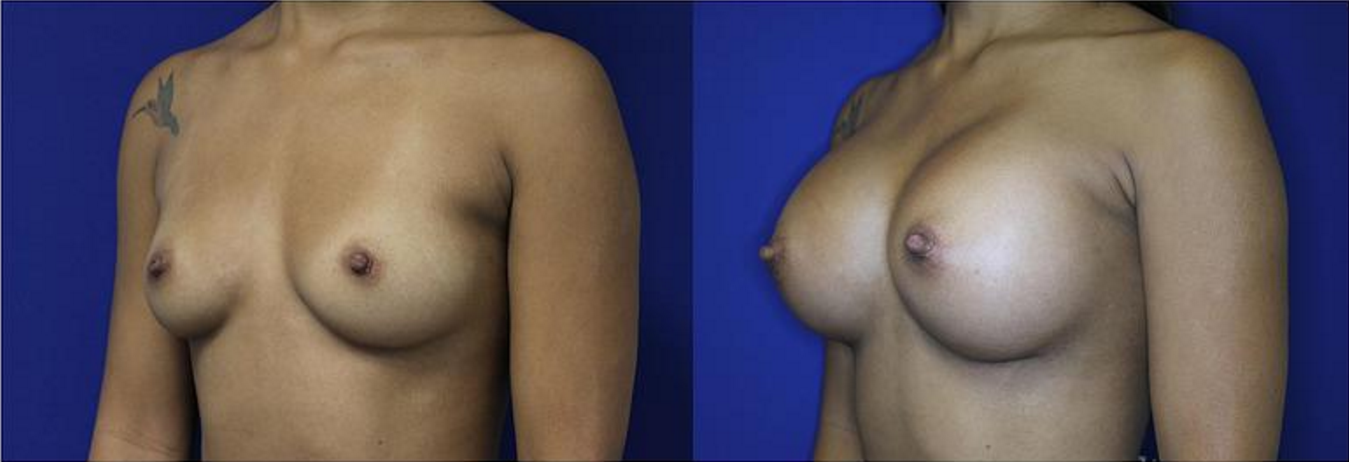 patientBreast Augmentation