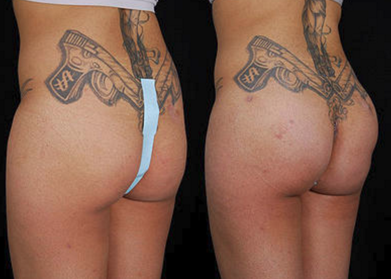 Buttock Augmentation - View 2