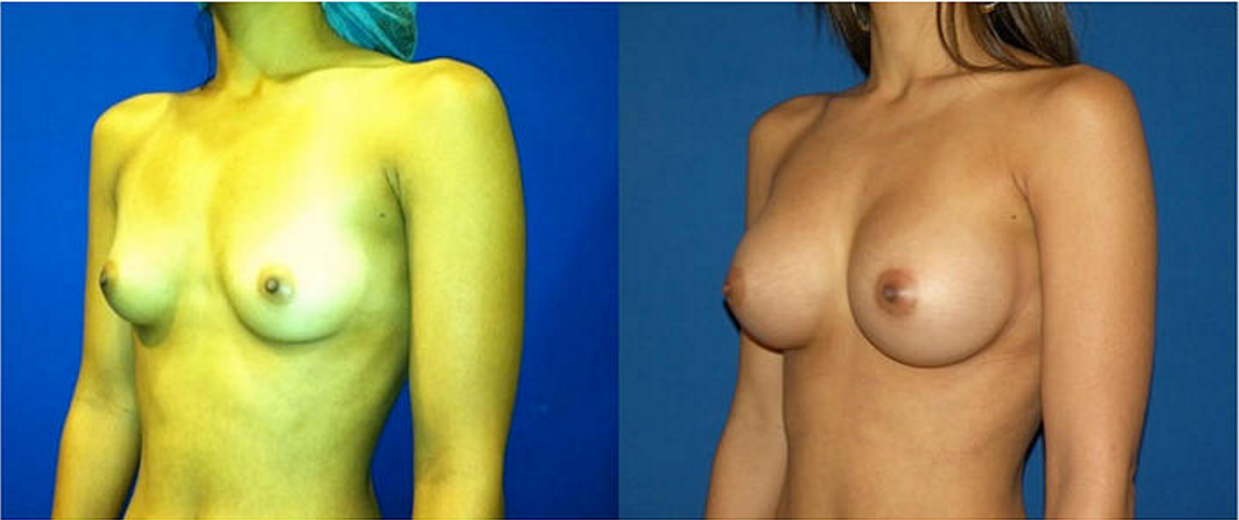 Breast Augmentation, Breast Implant